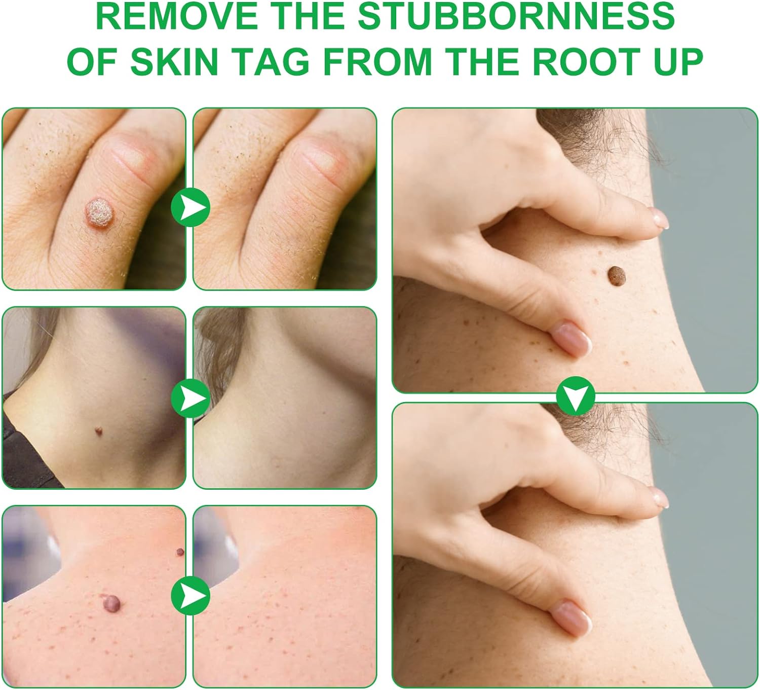 Crema pentru indepartarea negilor si alunitelor , 20 gr. Aliver Crema pentru indepartarea negilor si alunitelor , 20 gr. Aliver